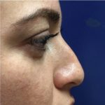 Nose Reshaping Before & After Patient #10662