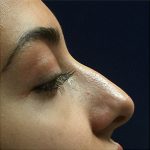 Nose Reshaping Before & After Patient #10668
