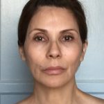 Juvederm Before & After Patient #10686