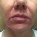 Juvederm Before & After Patient #10682